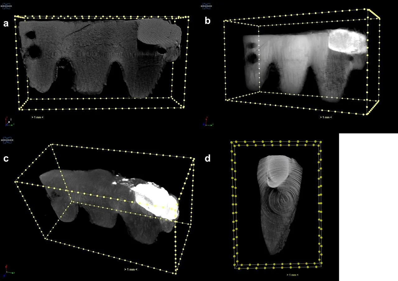 Rare 19th-century bone dental bridge found in Portugal points to early cosmetic tooth replacement